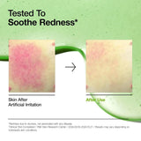 Anua Azelaic Acid 10 Hyaluron Redness Soothing Serum 30ml – Azelaic Acid & Hyaluronic Acid Serum for Redness & Blemish-Prone Skin